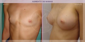 Before and after images of a breast augmentation procedure